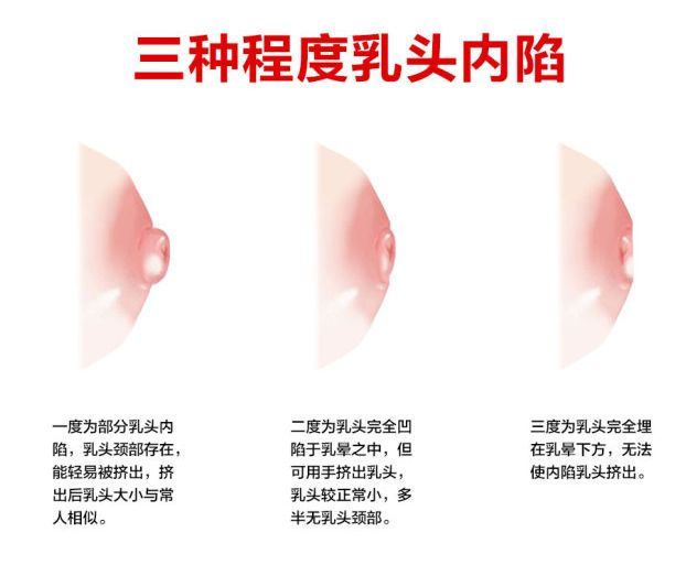 乳头凹陷的妈妈该如何哺乳？