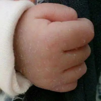 新生儿脱皮是正常的吗？