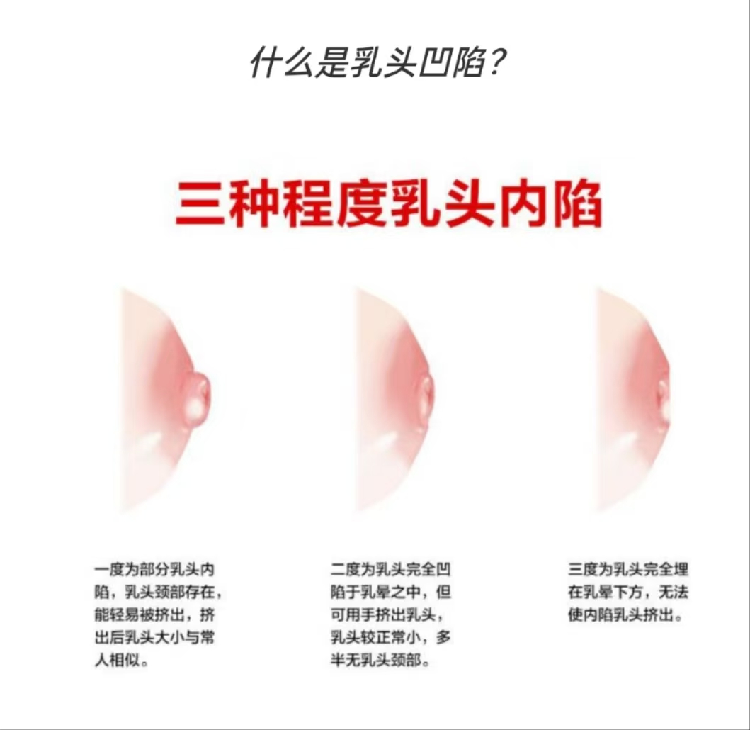 乳头凹陷的妈妈该如何哺乳？