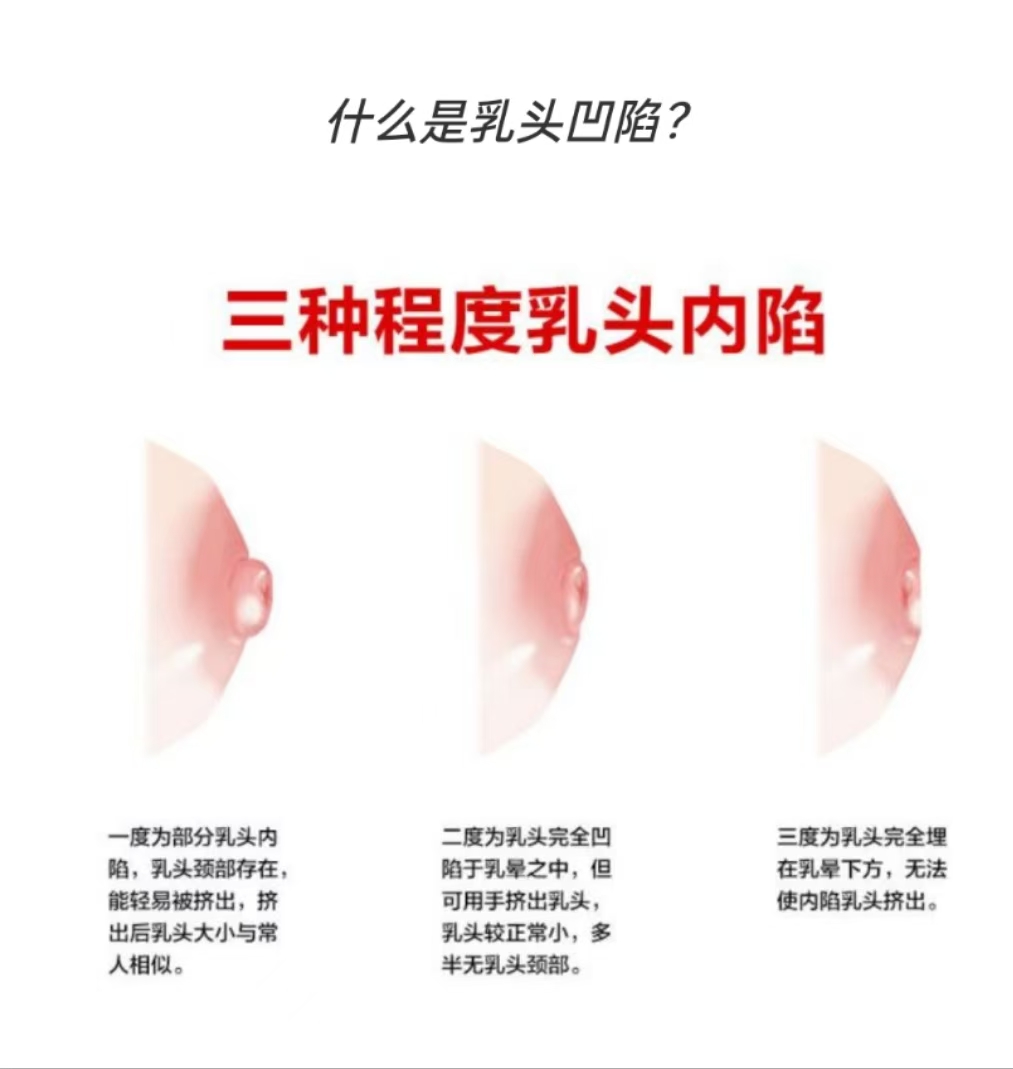 乳头凹陷妈妈也能成功哺乳：应对策略与孕期准备