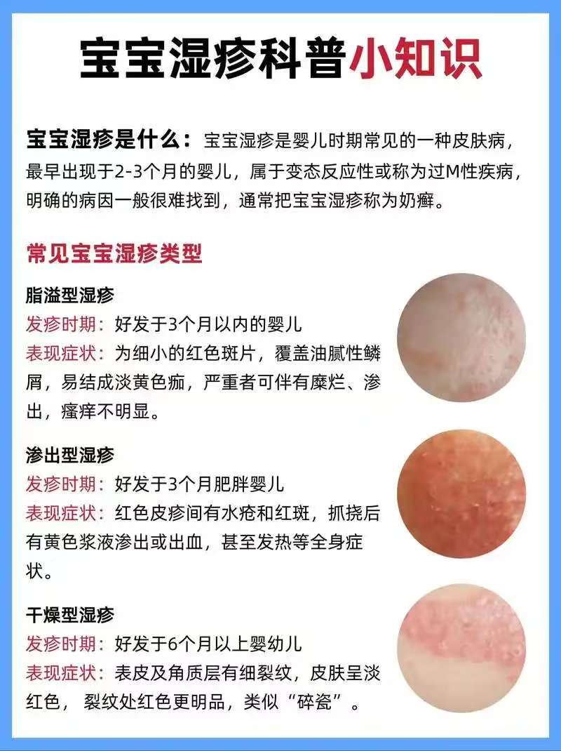 婴儿湿疹怎么治疗最好最快最有效